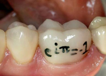 euler's identity on a porcelain crown in janet galore's mouth